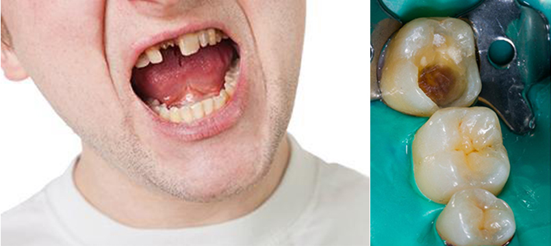 Broken Tooth Treatment