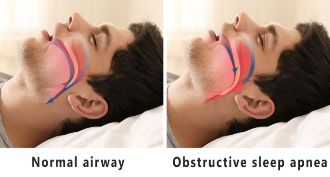 Sleep apnea Oral Appliance